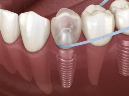 Los Implantes Dentales 